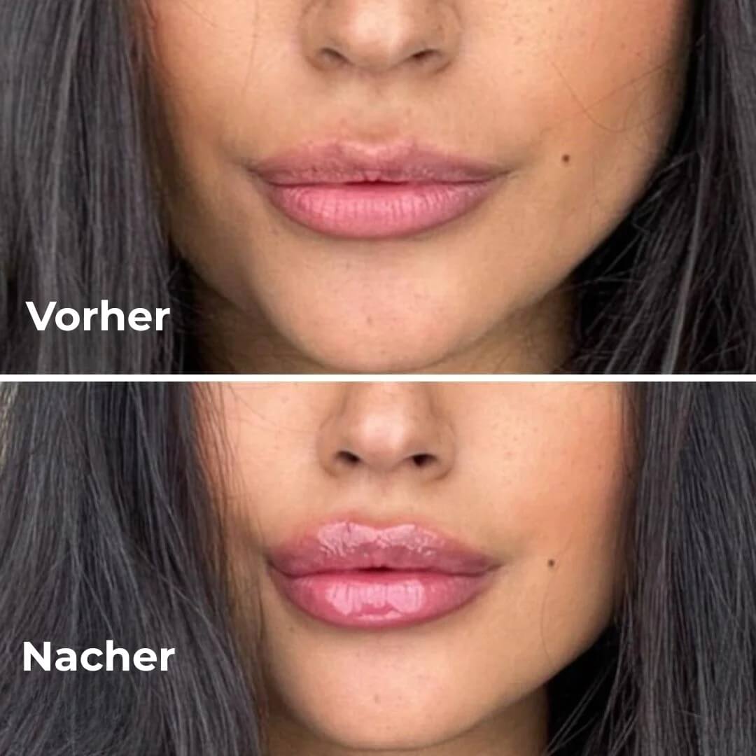JuicyLips Korean Lip Plumper